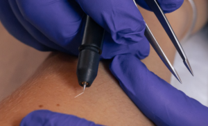 Needle Hair Removal