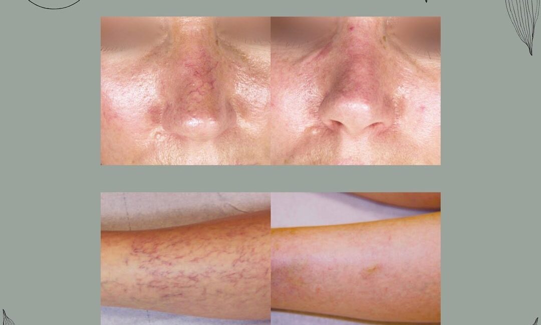 Capillary Removal with the DEKA Nd:YAG Laser