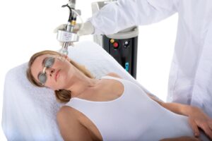 DEKA Co2 Laser