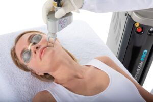 DEKA Co2 Laser